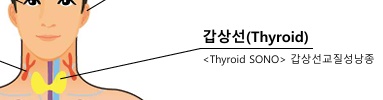 갑상선 교질성 낭종 이미지